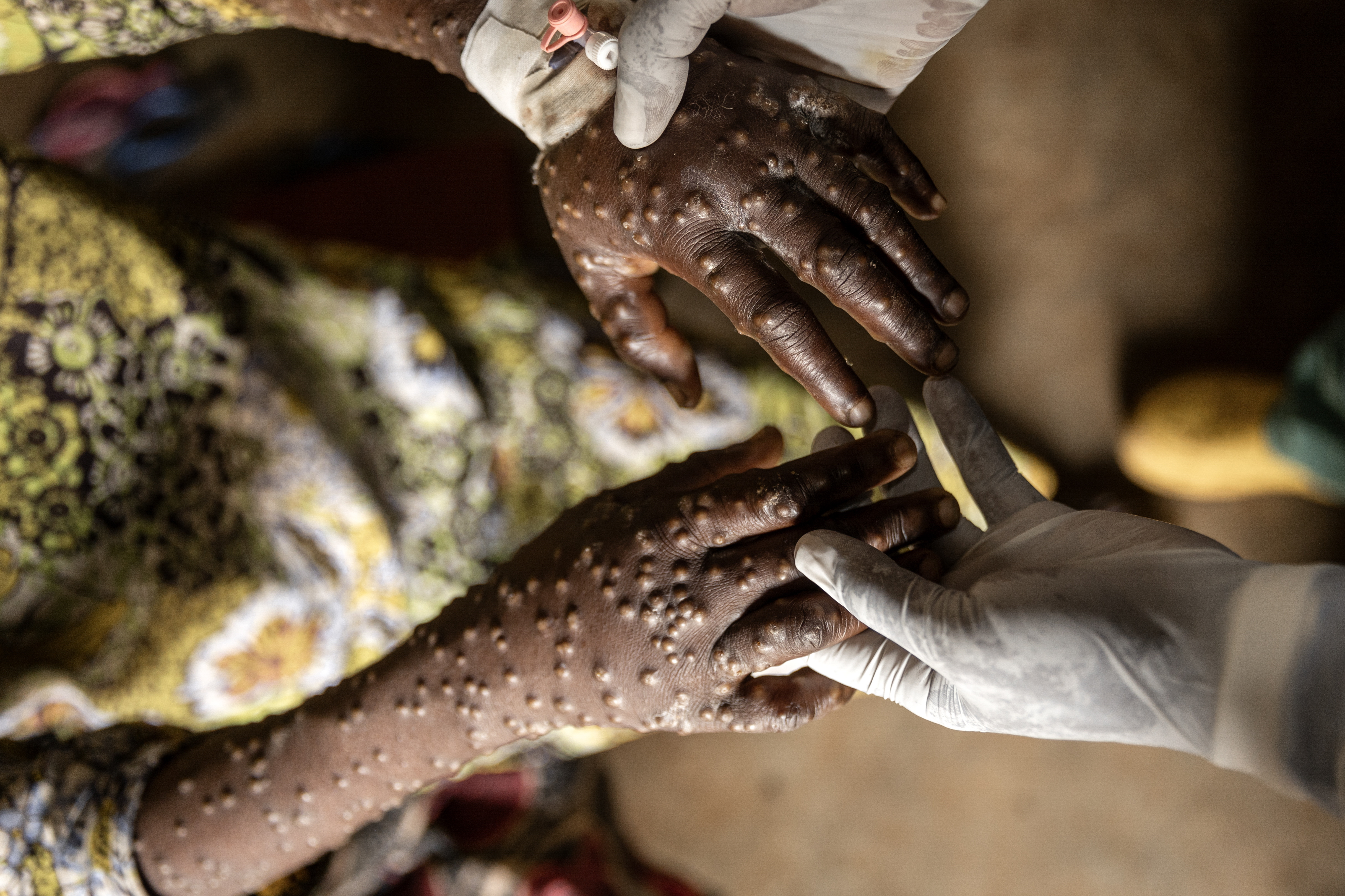 African Union: the Mpox epidemic is not under control